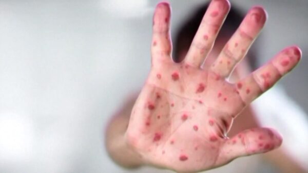 First Measles Case Confirmed in Dallas County Resident for 2025