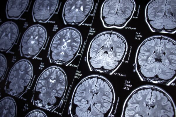 Emory University Researchers Discover Genetic Pathways to Alleviate Epileptic Seizures
